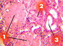 Амилоидоз почки (1-массы амилоида в строме; 2-амилоид в клубочке; 3-сохранившиеся канальцы)