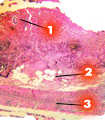 Острый флегмонозно-язвенный аппендицит (1-некротизированная слизистая; 2, 3- подслизистый и мышечный слои пропитаны гнойным экссудатом)