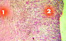 Грануляционная ткань (1-слой зрелой соединительной ткани; 2-'молодая' соединительная ткань с многочисленными капиллярами)